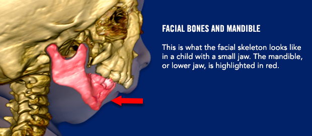 Facial Bones and Mandible This is what the facial skeleton looks like in a child with a small jaw. The mandible, or lower jaw, is highlighted in red.