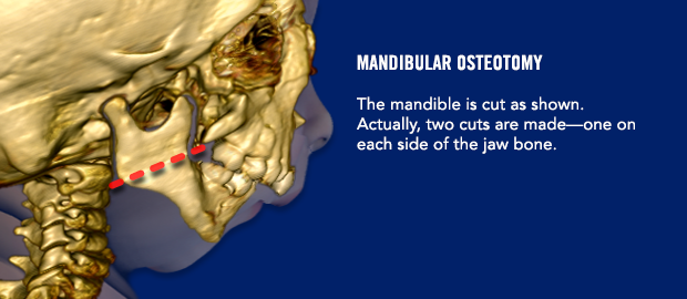Mandibular osteotomy