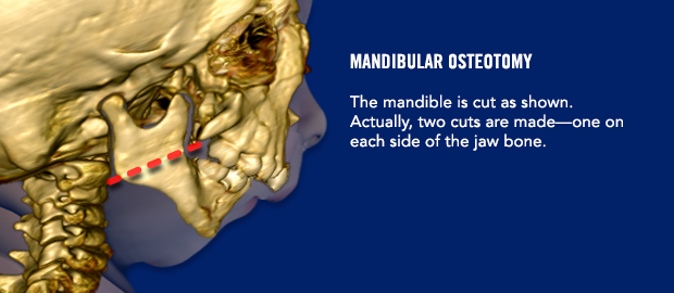 Mandibular osteomy The mandible is cut as shown. Actually, two cuts are made- one on each side of the jaw bone.