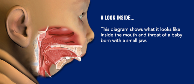 A look inside... This diagram shows what it looks like inside the mouth and throat of a baby born with a small jaw.