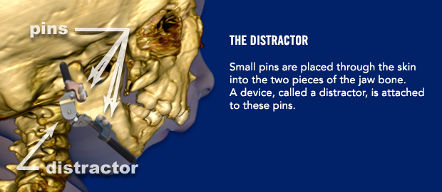 The Distractor Small pins are placed through the skin into the two pieces of the jaw bone. A device, callled a distractor, is attached to these pins.