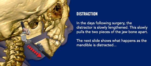 Distraction In the days following surgery, the distractor is slowly lengthened. This slowly pulls the two pieces of the jaw bone apart. The next slide shows what happens as the mandible is distracted...