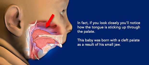 Airway Obstruction cont.