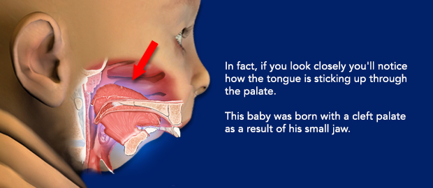 In fact, if you look closely you'll notice how the tongue is sticking up through the palate. This baby was born with a cleft palate as a result of a small jaw.