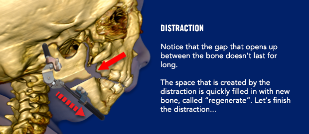 Distraction Notice that the gap that opens up between the bone doesn't last for long. The space that is created by the distraction is quickly filled in with new bone, called "regenerate". Let's finish the distraction...