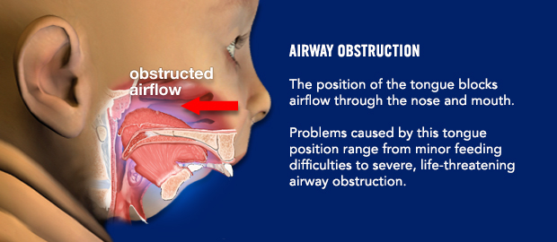 Airway obstruction. The position of the tongue blocks airflow through the nose and mouth. Problems caused by this tongue position range from minor feeding difficulties to severe, life-threatening airway obstruction.