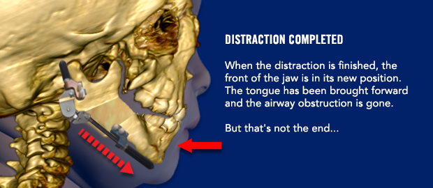 Distraction completed When the distraction is finished, the front of the jaw is in its new position. The tongue has been brought forward and the airway obstruction is gone. But that's not the end...