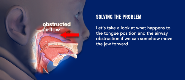 Solving the problem. Let's take a look at what happens to the tongue position and the airway obstruction if we can somehow move the jaw forward...