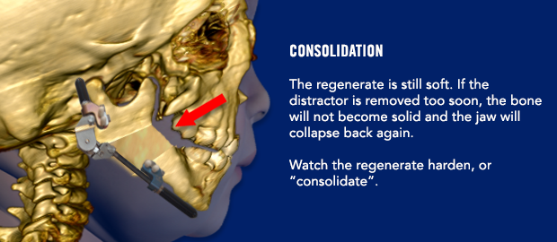 Consolidation The regenerate is still soft. If the distractor is removed too soon, the bone will not become solid and the jaw will collapse back again. Watch the regenerate harden, or "consolidate".