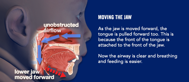 Moving the jaw. As the jaw is moved forward, the tongue is pulled forward too. This is because the front of the tongue is attached to the front of the jaw. Now the airway is clear and breathing and feeding is easier.