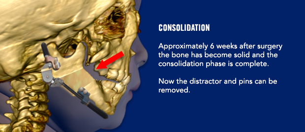 Consolidation Approximately 6 weeks after surgery the bone has become solid and the consolidation phase is complete. Now the distractor and pins can be removed.