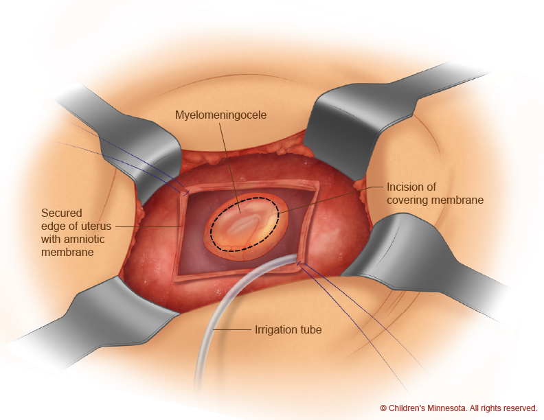 Spina Bifida incision diagram