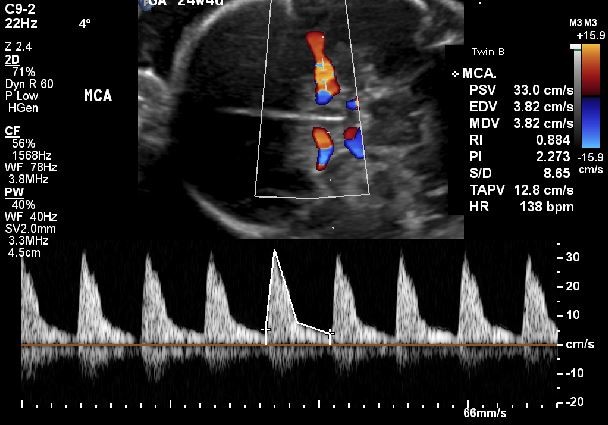 a sample of an ultrasound measuring MCA in a fetus