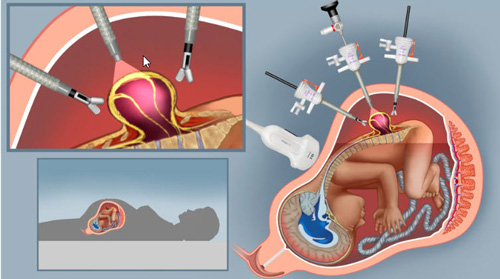 fetoscopic surgery