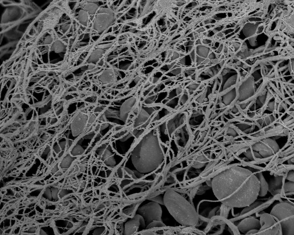 Step 3: Secondary hemostasis, where a fibrin net forms.