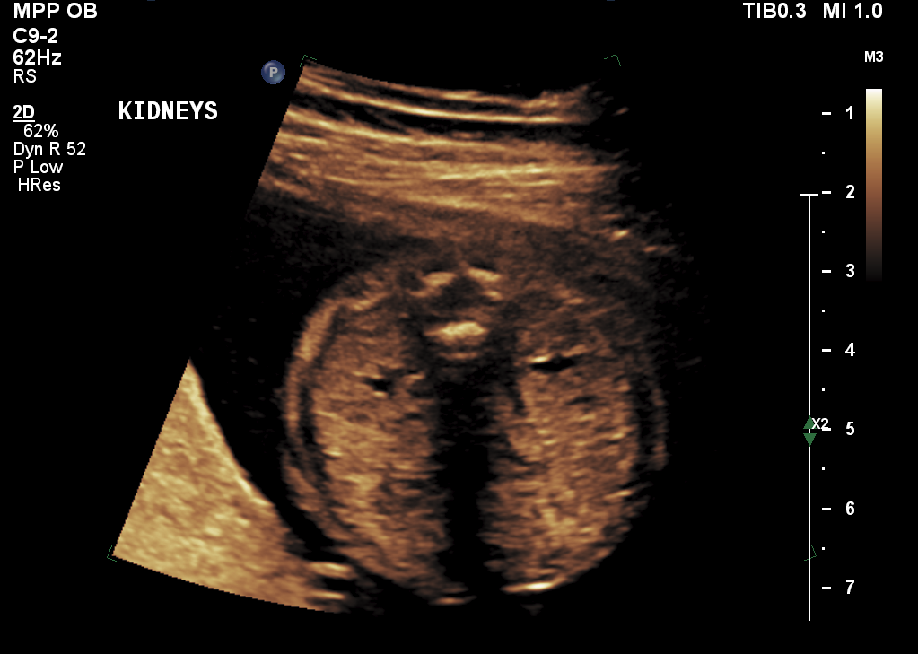 MWFCC Conditions: Renal Agenesis