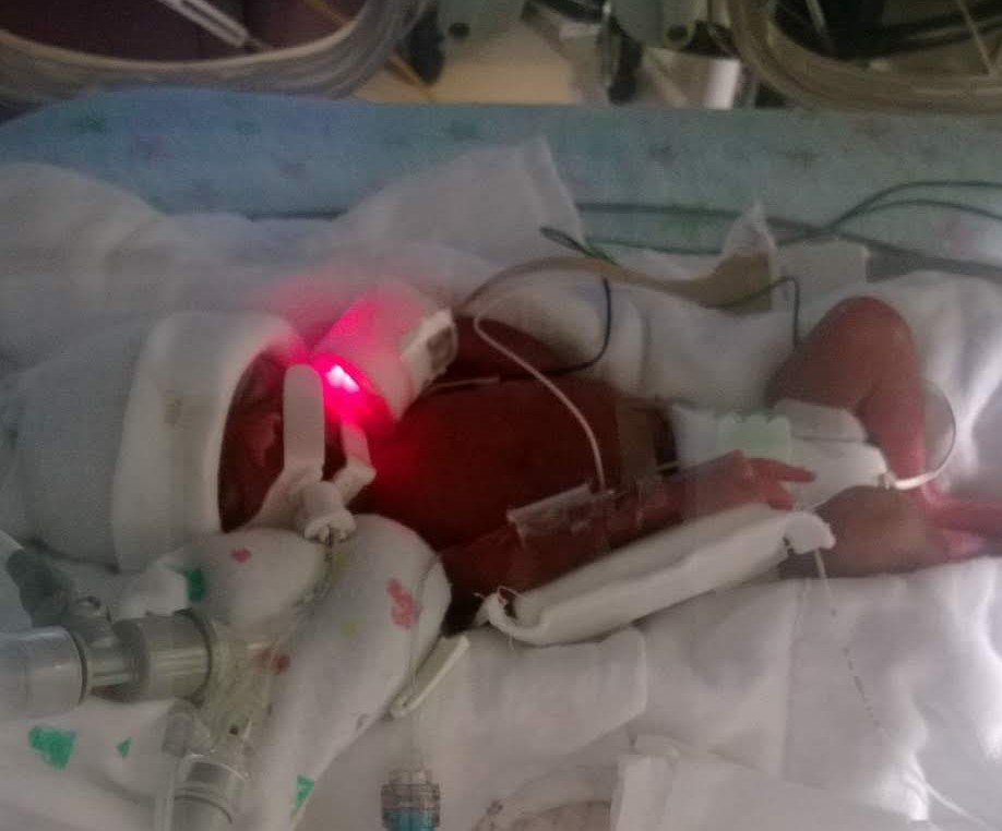 One of the twins in the NICU