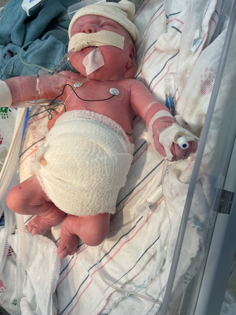 Baby Hallie in hospital bed.