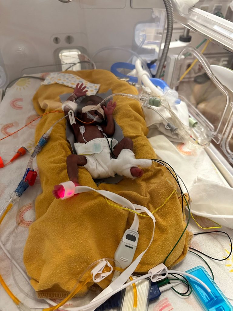 Baby Bilal in the Neonatal Intensive Care Unit at Children's Minnesota.