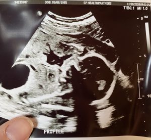 Baby Jabari ultrasound