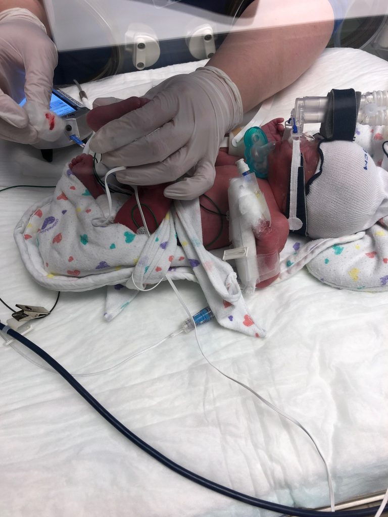 Barrett shortly after birth in the neonatal intensive care unit