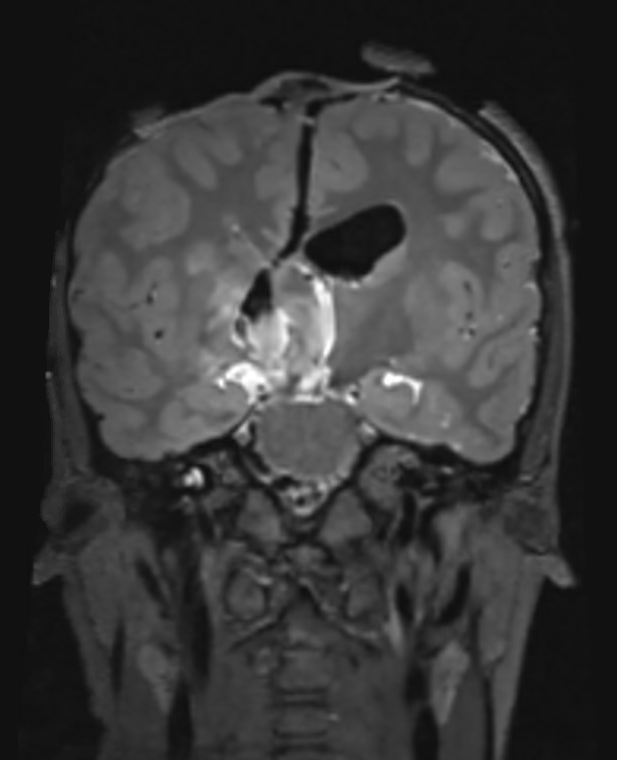 A mid-procedure MRI scan from inside the suite shows John’s tumor is removed
