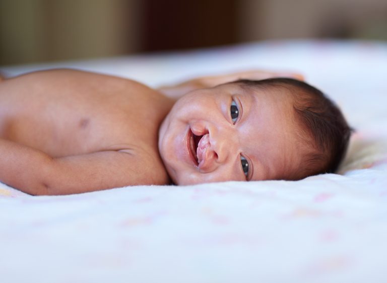 Smiling baby girl that has a cleft lip lying on a bed.