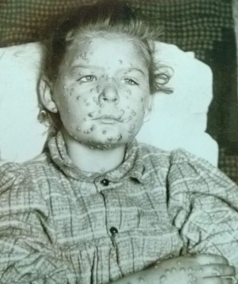 A photo of a girl with smallpox, taken in Minnesota around 1900.