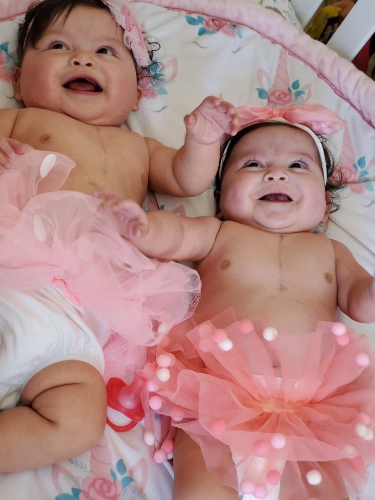 Luna and Sol smiling and wearing tutus. There are scars on their chests from the surgeries to fix their congenital heart defects.