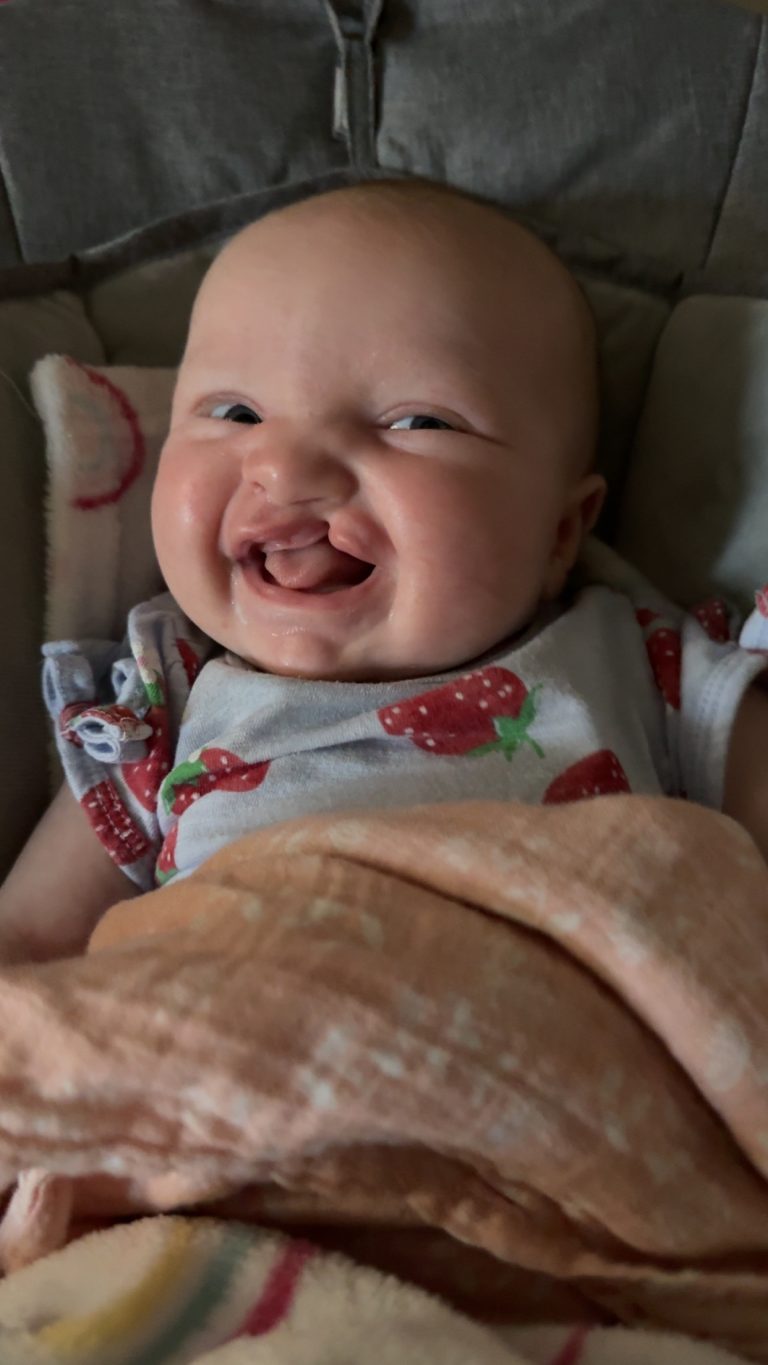 Luna smiling with a visible cleft lip