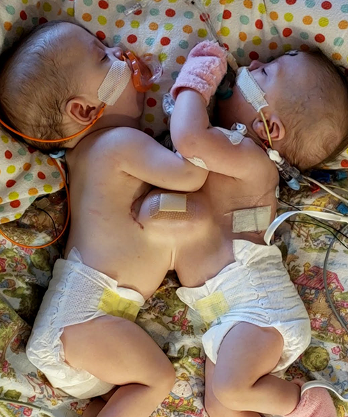 Remi and Reese still conjoined
