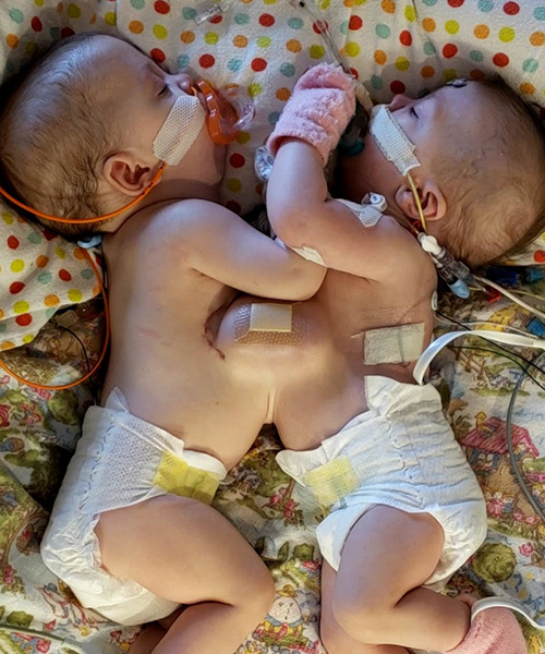Remi and Reese after birth, still conjoined