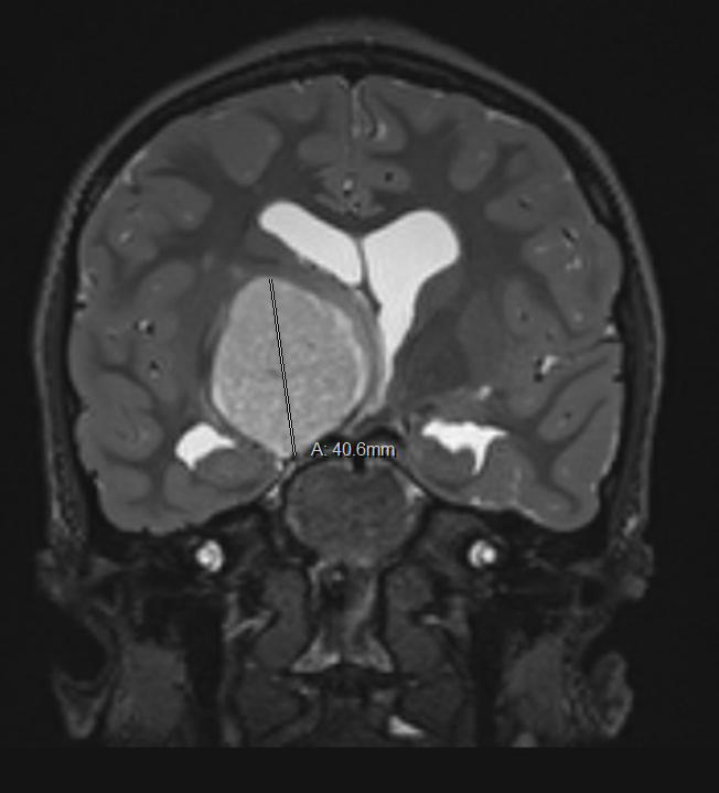 An MRI revealing John's golf ball-sized brain tumor