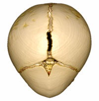 An image of a skull demonstrating Craniosynostosis Metopic