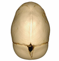 An image of a skull demonstrating Craniosynostosis Sagittal