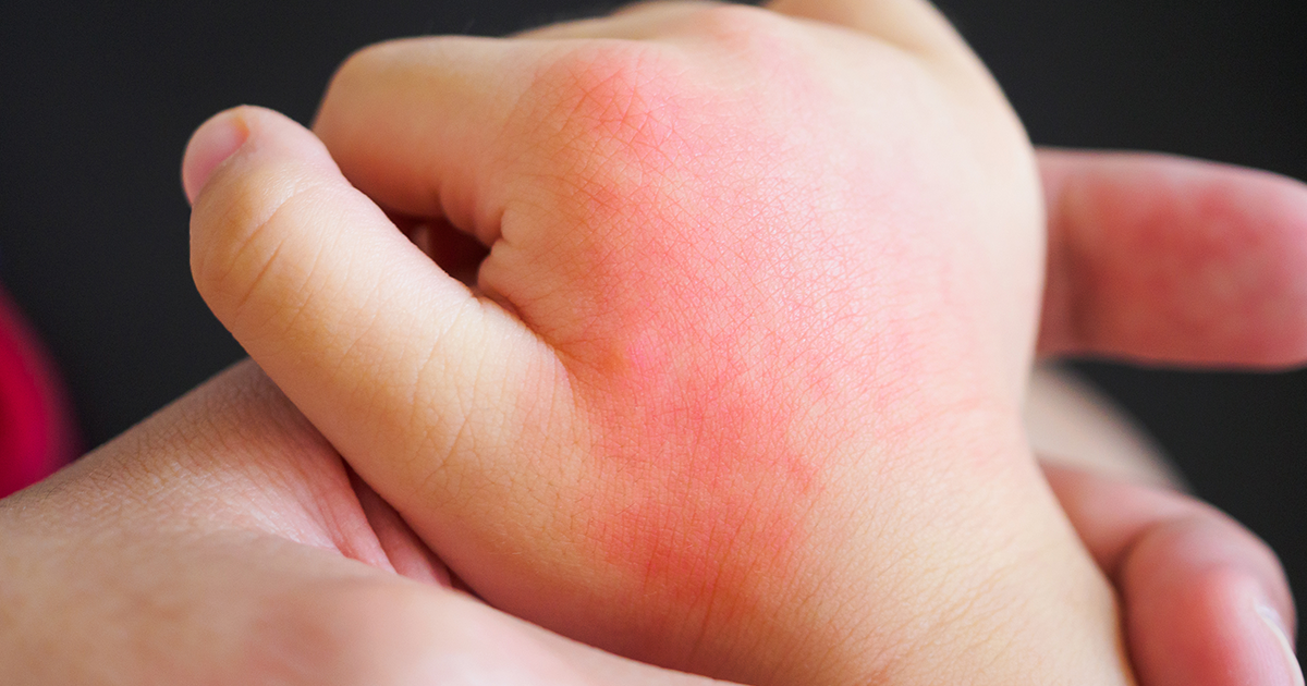 Let’s not be rash: diagnosing rashes and reactions that occur during or ...