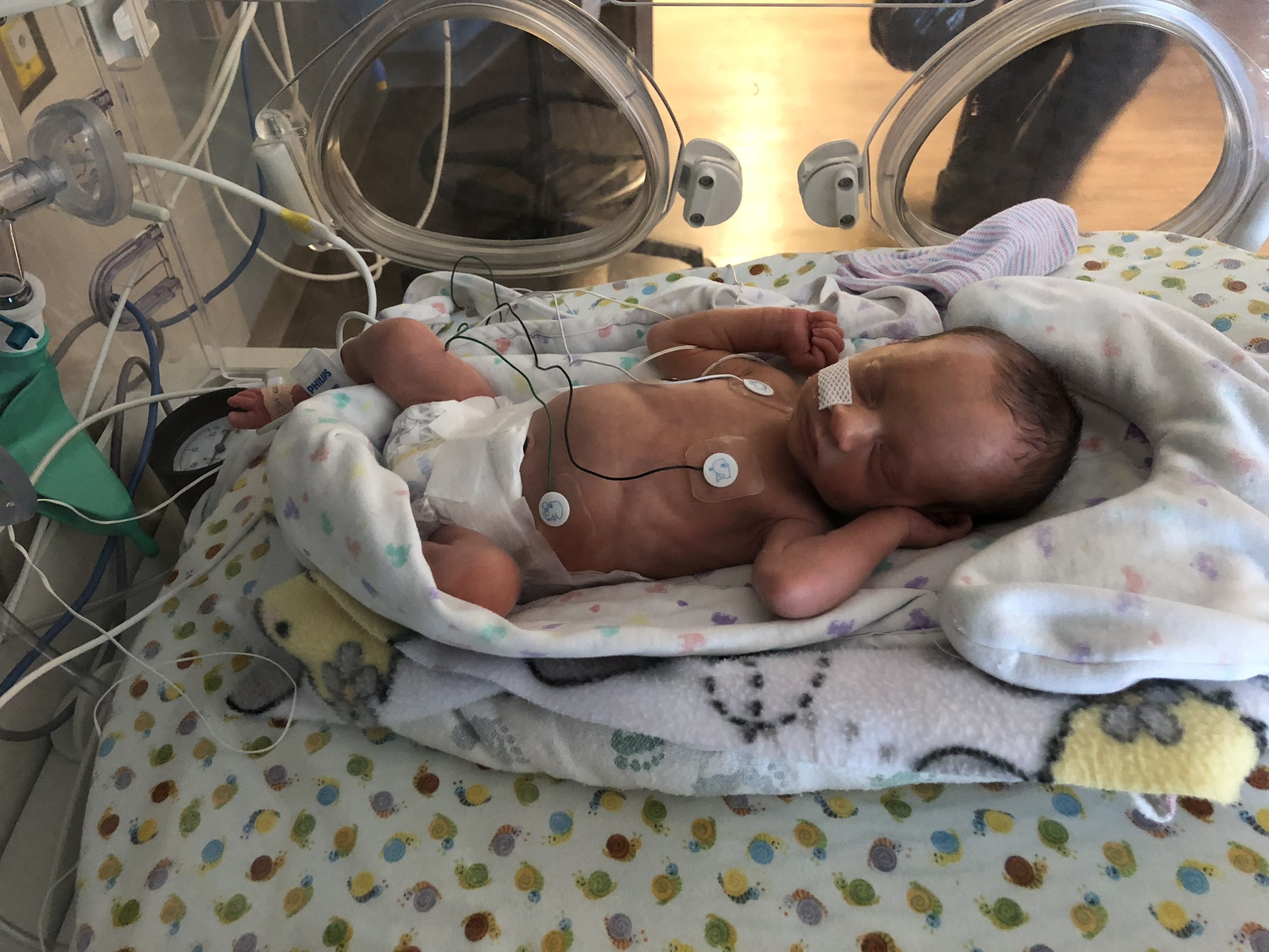 One of the newborn twins in the hospital