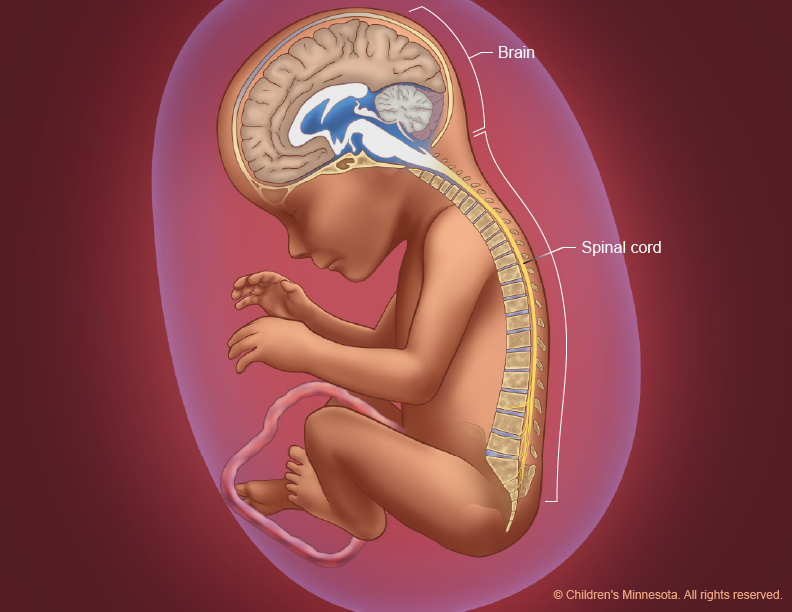 Spina Bifida Figure 1