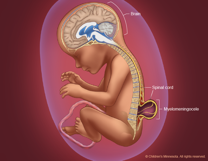 Spina Bifida Figure 3