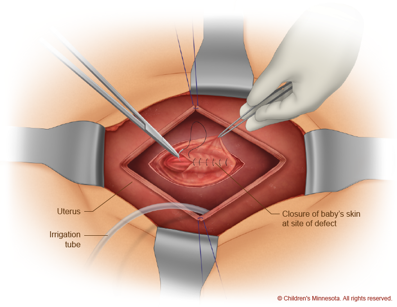 Spina bifida skin closure diagram