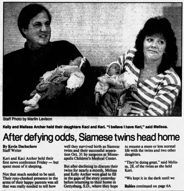 A 1991 Star Tribune article about a Children's Minnesota surgery separating conjoined twins.