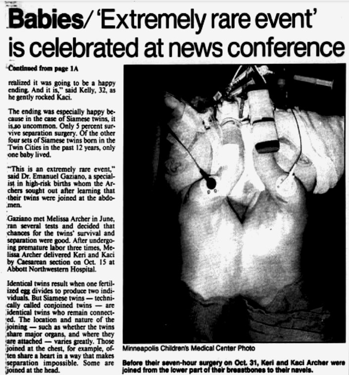 A 1991 Star Tribune article about a Children's Minnesota surgery separating conjoined twins.