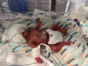 Lilia in the hospital after being born