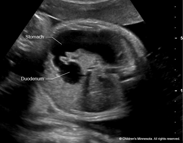 Figure 3 - The classic sign of duodenal atresia shows up on an ultrasound as a “double bubble” (a fluid-filled stomach and a fluid-filled duodenum) in the abdomen.