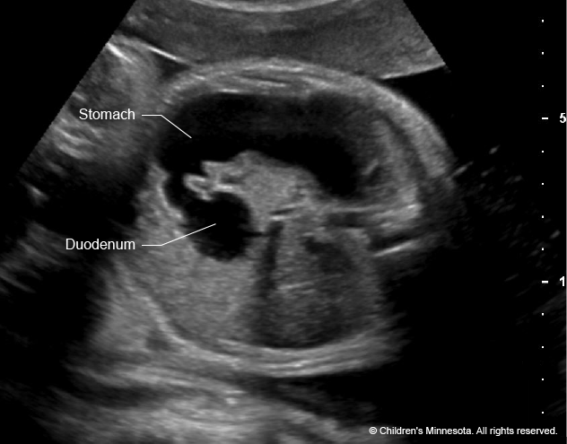 extra amniotic fluid