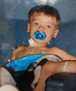 Trever as a toddler with a scar on his chest from a surgery for his heart condition.