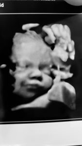 Xander ultrasound picture