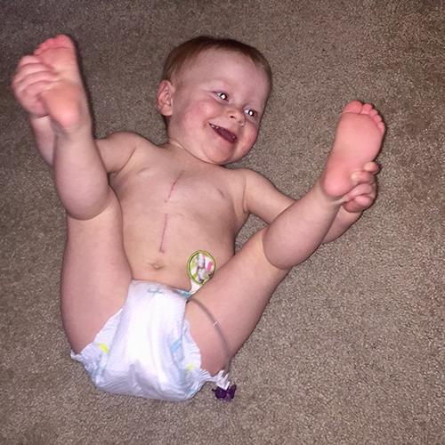 Kenzie as a child with scars.