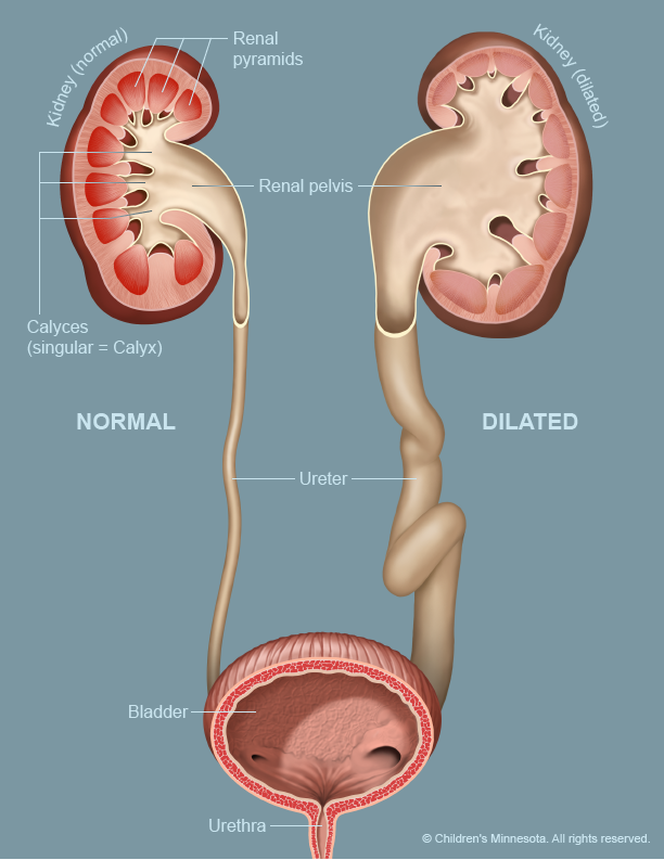 Urinary Tract Dilation image