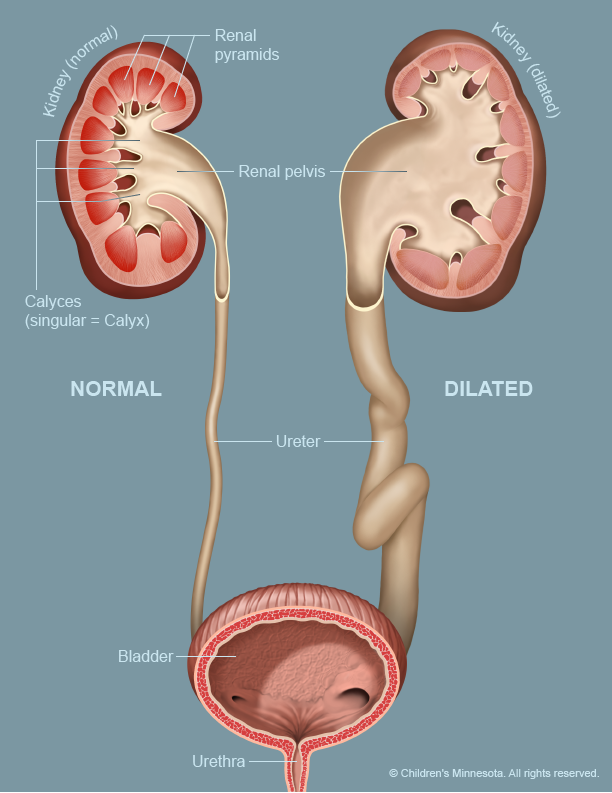 Urinary Tract Dilation image